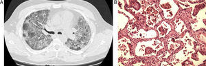 (A) Diffuse interstitial infiltrate in both lungs, as observed on thoracic CT. (B) Interstitial inflammation and fibrosis under strong magnification in bronchiolitis interstitial pneumonitis.