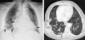 On the left, chest radiography after surgical biopsy revealing multiple bibasilar nodules predominantly on the right side (black arrows). On the right, computed tomography (CT) axial cut with pulmonary window showing bibasilar peripheral hyperdense nodules with poorly outlined edges that are larger in size in the right hemithorax (white arrows).
