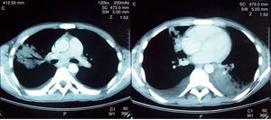 Thoracic computed tomography of the patient before treatment showing pulmonary infiltrates as well as pleural effusion.