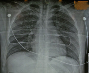 Chest radiography of a valid non-heart-beating donor.