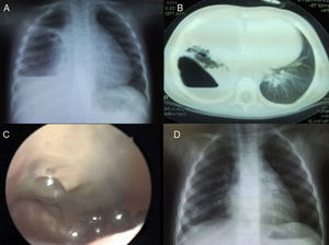 (A) Chest radiography demonstrating a cavity with air–fluid level in its interior in the right hemithorax. (B) Pre-operative CT shows a lesion compatible with abscessed necrotizing pneumonia in the right lower lobe. (C) Intraoperative image of the lung abscess; note the greenish appearance of the parenchyma and the surrounding air bubbles caused by the BPF. (D) Radiological check-up 2 months after surgery.