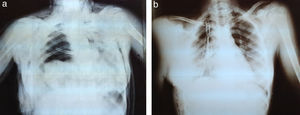 Tracheobronchial trauma injury. (a) Lung not visible after a fall, with surgical emphysema; chest tube inserted in the emergency department. (b) Post-op image: surgical emphysema being resolved, multiple rib fractures.