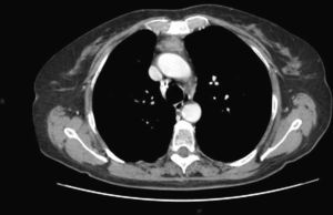 Chest computed tomography (CT) after the administration of contrast medium revealing a retrosternal mass.