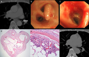 (a) Computed tomography revealed an endobronchial lesion measuring 1cm in diameter (arrow). (b) Polypoid mucous lesion located in the left lower lobar bronchus as seen on flexible bronchoscopy. (c) After the total extraction of the polypoid mucous lesion with biopsy forceps. (d) The endobronchial polypoid mass was mainly made up of bone, cartilage and fatty tissue and covered with respiratory epithelium (hematoxylin–eosin stain, ×40). (e) The bone contained myeloid elements, which would suggest true bone marrow (hematoxylin–eosin stain, ×200). (f) Computed tomography showing the elimination of the polypoid lesion 12 months after the bronchoscopic procedure.