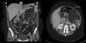Pre-transplantation abdominal CT with a large heterogeneous mass in the left kidney.