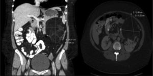 Reduction of the size of the left renal angiomyolipoma on a follow-up abdominal CT after transplantation and 6 months of treatment with everolimus.