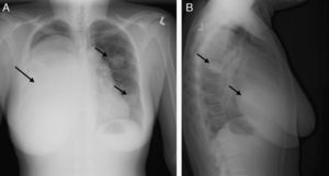 (A and B) Posteroanterior and lateral projections of chest radiography show a homogenous opacity on the right side affecting most of the right lung, with pleural effusion and deviation of the trachea toward the left. Two round coin-shaped opacities are also observed in the left hemithorax.
