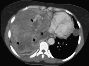 Thoracic computed tomography with intravenous contrast showing a large heterogeneous mass on the right side, with multiple foci of necrosis (arrow heads) and deviation of the mediastinum toward the left.