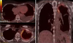 PET/CT fusion imaging demonstrating 2 foci of pathologic hypermetabolism in the left pleural apical area (SUV 6.8g/ml) and in the left basal subpleural region (SUV 3.8g/ml).