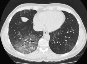 Thoracic computed tomography at diagnosis.