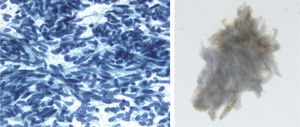 Material from the fine-needle aspiration, fixed in alcohol and stained with Papanicolaou. Very cellular frotis with abundant loose cells. The cells are monotone with regular, oval and round nuclei, granular chromatin without nucleolus. Immunocytochemistry: positive chromogranin (cytoplasmic and granular).