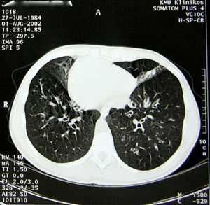 Thoracic computed tomography of the patient at the age of 18.