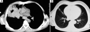 (A) Computed tomography (CT) of the mediastinal window showing a mass with soft tissue density located in the right middle lobe with cavitation and surrounding consolidation. (B) CT of the lung window one year after wedge biopsy showing a linear fibrotic opacity in the right middle lobe.