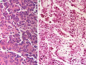 (A) Transbronchial biopsy showing layers of plasma cells. (B) Open lung biopsy showing plasma cells and lymphocytes (hematoxylin and eosin stain).