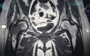 Magnetic resonance imaging in T1 showing a central and expansive image with aggressive characteristics located at the major trochanter and neck of the right hip (arrow).