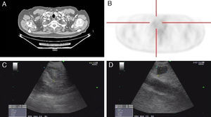 (A) Axial chest CT slice in the mediastinal window showing an upper right paratracheal nodule. (B) The cross-sectional PET-CT slice shows evidence of a right upper paratracheal lesion that is discretely hypermetabolic. (C) Ultrasound image of the lower right paratracheal lymphadenopathy, measuring 13mm×10mm, with a fatty center. (D) Subglottic hypoechogenic nodular image, measuring 8mm×7mm, corresponding with a thyroid cyst.