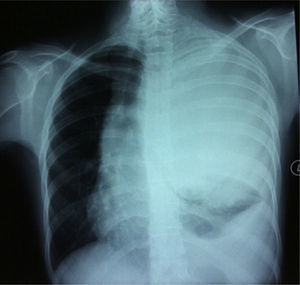 Plain chest radiography (posteroanterior projection) showing a large opacity that occupies the entire left hemithorax.