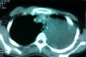 Axial chest CT with contrast medium demonstrating a hypodense mass in the left hemithorax contiguous to the mediastinal vessels.