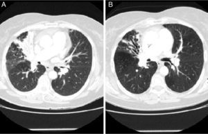 (A) Partial condensation and atelectasis of the anterior segmental bronchus of the right upper lobe (RUL). (B) Follow-up CT after 6 months of treatment showing partial resolution of the infiltrate together with more evident bronchiectasis in said lobe than at the start of treatment.