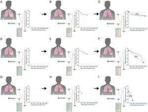 In a pleural effusion with a normal lung (A), initial PP is mildly positive. As the liquid is withdrawn (B), PP falls slowly and the lung expands progressively. Once all the effusion is withdrawn (C), the lung comes into contact with the chest wall and PEL becomes normal. In lung entrapment, the visceral pleura has a slight thickening and the initial PP is, as in a normal lung, mildly positive (D). When the fluid is drained, the lung expands progressively and PP slowly descends (E). At this point, the lung becomes trapped and cannot expand more; PP will drop rapidly, producing elevated PEL with a bimodal pressure/volume curve (F). In trapped lung, the visceral pleura has a thicker layer of fibrin that keeps the lung from expanding, and therefore initial PP will be negative (G). The withdrawal of the liquid, on the one hand, and the lung rigidity, on the other hand, cause PP to descend rapidly (H), which leads to high PEL (I).