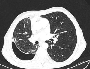 Thoracic computed tomography with air contrast demonstrating abnormal thickening of the visceral pleura, which impedes the normal expansion of the lungs.