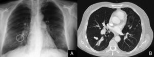 (A) Chest radiograph after the closure of the pulmonary arteriovenous malformation (AVM) showing the Amplatzer intravascular device (circled in white); (B) chest computed tomography with intravenous contrast demonstrating pulmonary AVM occluded by the Amplatzer intravascular device (white arrow).