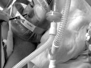 Helmet-type interface for non-invasive mechanical ventilation; by insertion of the bronchoscope through a fenestrated piece, either the nasal or oral approach can be used.