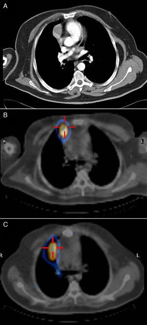 Radiological study. (A) Computed tomography detecting an anterior mediastinal mass. (B) SPECT/CT confirming the paracardiac mass suspicious for thymic carcinoid tumor. (C) SPECT/CT of the suspected relapse.