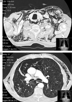 (A and B) Thoracic CT image showing the presence of gas in the subcutaneous and mediastinal tissue.
