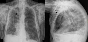Posteroanterior and lateral chest radiography showing massive accumulation of air in the subcutaneous tissue. The proximal end of the subcutaneous drain can be observed in the third right intercostal space (arrows).