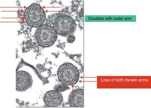 Ultramicroscopic changes in primary ciliary dyskinesia.