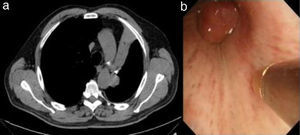 (a) Chest CT image in which stenosis of the left main bronchus and ipsilateral hilar adenopathies leading to left upper lobe collapse can be observed. (b) Bronchoscopic image showing the cryoprobe and endobronchial lesion in the left main bronchus.