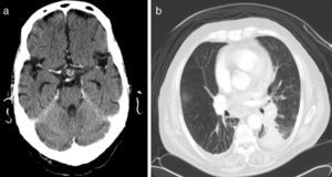 (a) Cranial CT scan: pituitary lesion. (b) Chest CT scan: lesion in the left lower lobe indicative of malignancy.