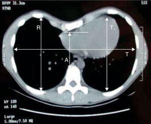 The CT scan shows the sternal torsion and chest measurements.
