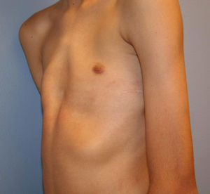 Mixed pectus excavatum/carinatum.
