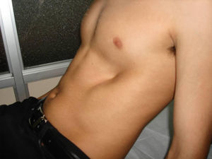 Unilateral inferior indentation.