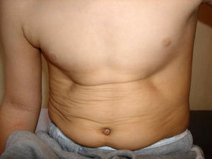 Bilateral inferior indentation.