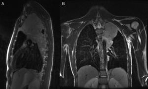 Non-contrast chest MRI (T2 sequence): lobulated mass in the upper region of the left hemithorax, of extrapulmonary appearance, derived from the pleura. (A) Sagittal section. (B) Coronal section.