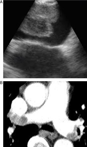 (A-B) Images of an embolism in the right pulmonary artery on the EBUS.