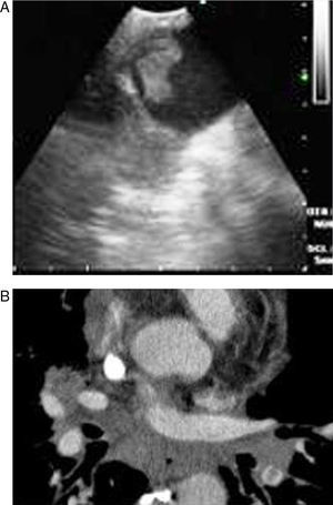 (A-B) Bilateral embolism in the central pulmonary artery in the chest CT scan.