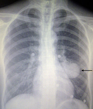Pneumocytoma in the left hemithorax on the X-ray (arrow).