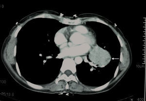 Left infrahilar location on the chest CT scan (arrow).