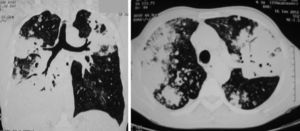 The chest computed tomography revealed consolidation in both lungs with air bronchogram.