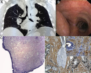 The chest CT scan shows a mass with stenosis of the distal part of the trachea (5cm long) and left main bronchus (Part A). Endoscopic visualization shows a mass protruding from the lateral wall of the distal trachea, causing considerable occlusion of the trachea and orifice of the left main bronchus (Part B). The tracheal mucosa is thickened due to the presence of an amorphous substance, despite being covered by normal epithelium (hematoxylin and eosin stain, magnification ×40, Part C). The amorphous substance is selectively stained with Congo red (magnification ×400; Part D). Inset: detection of amyloid P using immunohistochemical methods (magnification ×400).