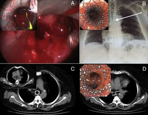 After complete resection of the mass (Part A), placement of the Y-stent was ensured by inserting a guidewire into each main bronchus (inset, Part A). The observations made on the chest X-ray (white arrow; Part B) and endoscopy (inset, Part B) confirmed complete expansion of the device. Five months later, the CT scan (Parts C and D) and bronchoscopy (inset, Part D) showed normal patency of the tracheobronchial tree, with no recurrence of amyloid deposition.