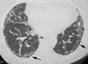 HRCT at the level of the lung bases, showing a subpleural “reticular pattern” and the presence of multiple small cysts representing associated areas of honeycombing (arrows).