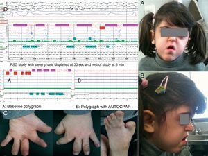 (A and B) Characteristic facies of Apert syndrome with facial hypoplasia. (C) Syndactyly and sclerodactyly. (D) Patient's baseline polysomnography showing predominance of obstructive apneas and recording from autoCPAP connected to the polygraph flow channels.