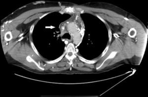 Mediastinal mass including and obliterating the superior vena cava, reducing the passage of iodated contrast (arrow).