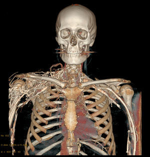 3D angiographic reconstruction showing the collateral circulation pattern due to compression of the superior vena cava.