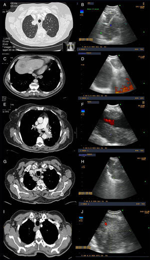 Examples of radiological and ultrasound images from four of the cases from the series. (A and B) Computed tomography (CT) and endoscopic ultrasound images of a mass located in the right upper lobe, aspirated using endobronchial ultrasound, the result of which was adenocarcinoma of pulmonary origin. (C and D) CT and endoscopic ultrasound images of a patient with a pulmonary lesion in the left lower lobe and lymphadenopathy in right mediastinal station 9. Both were aspirated using endobronchial ultrasound via the oesophagus; the result in both was colon cancer metastasis. (E and F) CT and endoscopic ultrasound images of a left hilar mass surrounding the pulmonary artery, with EBUS-guided needle aspiration diagnostic of adenocarcinoma of pulmonary origin. (G and H) CT and endoscopic ultrasound images of a right paratracheoesophageal mass possibly originating in the right upper lobe, with needle aspiration carried out via the oesophagus, resulting in a diagnosis of adenocarcinoma of pulmonary origin. (I and J) CT and endoscopic ultrasound images of a mass located in the right upper lobe infiltrating the mediastinum. EBUS-guided fine needle aspiration was performed with a result of adenocarcinoma of pulmonary origin.